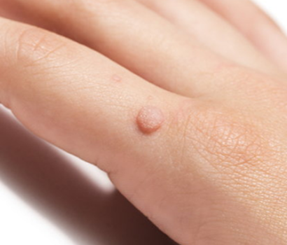 Warts Remova